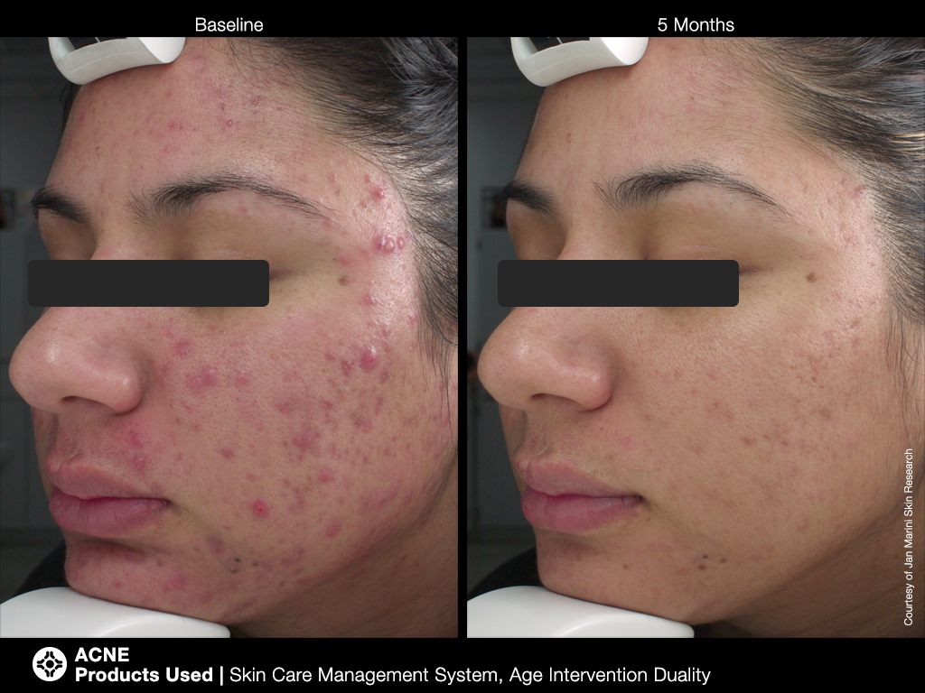 jan marini skin research before and after the skin care management system